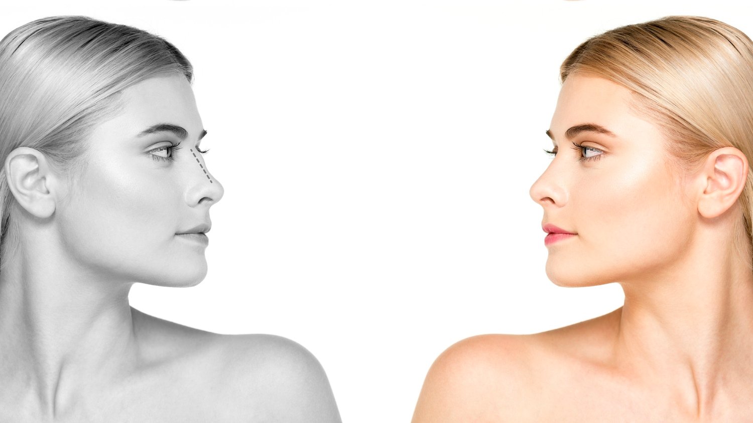 SCAR-FREE NOSE AESTHETICS RHINOPLASTY